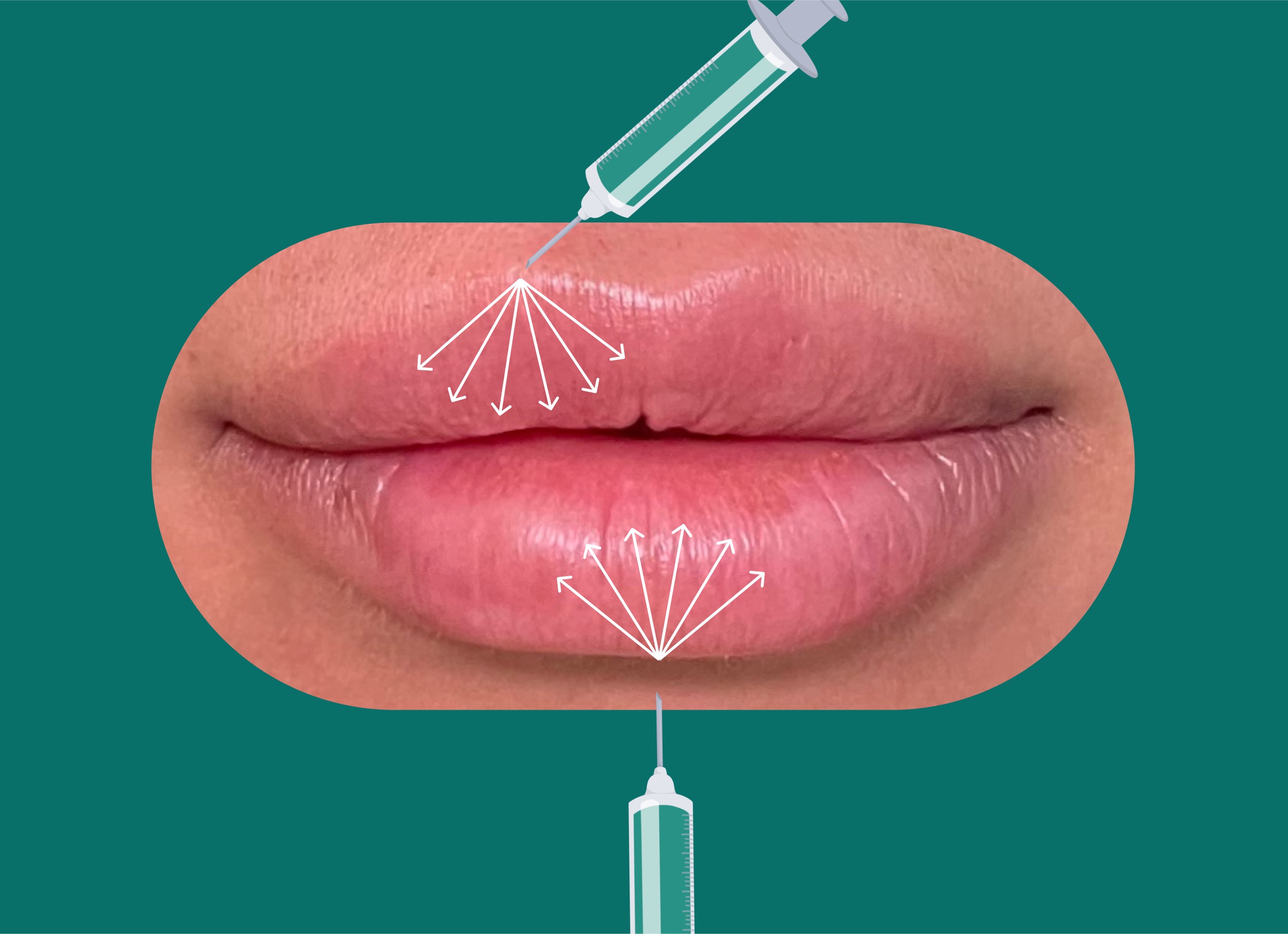 Upkeep What is Russian Lip Filler?